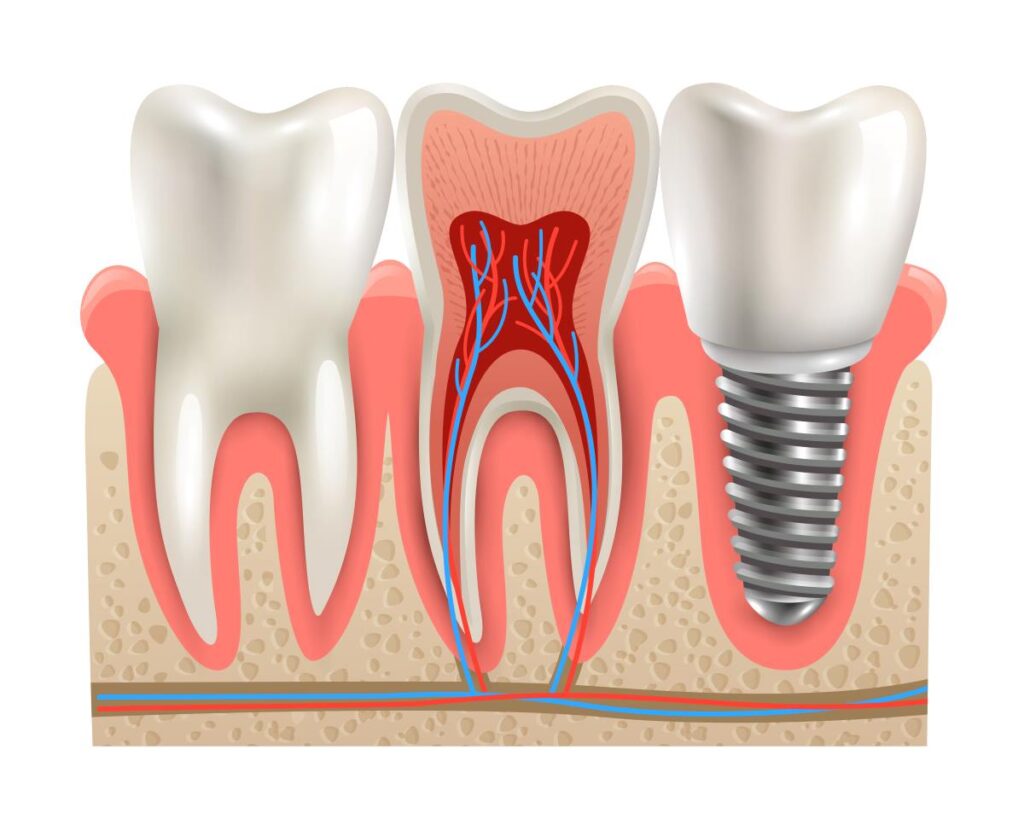 Konya’da implant tedavisi: Sağlıklı ve estetik gülüşler için modern diş hekimliği hizmetleri sunan uzman tedavi.