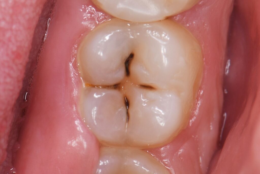 Diş çürüğünün oluşum sürecini gösteren diş yapısı ve plak birikimi görseli.