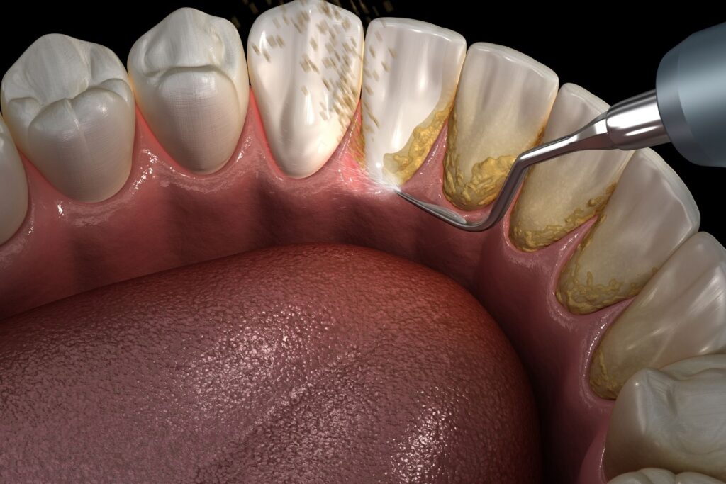 Diş taşı oluşumunu gösteren diş yüzeyi ve plak birikimi diyagramı.