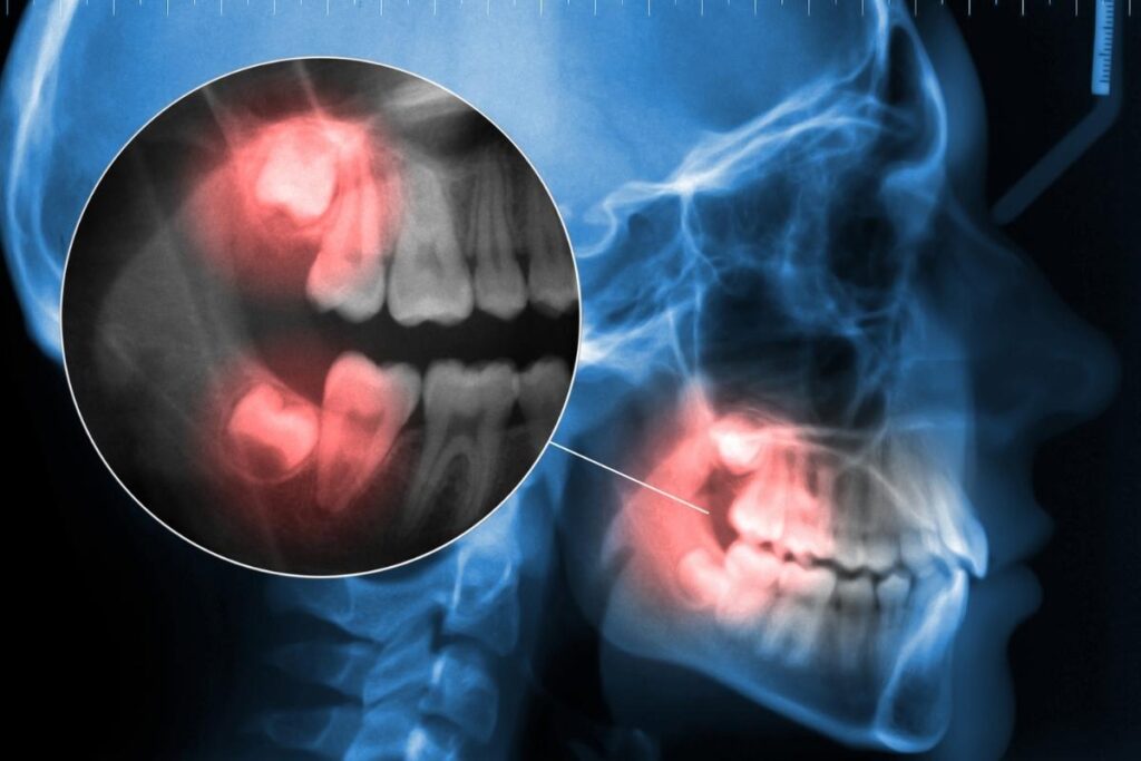 20’lik dişlerin konumunu, gömülü diş yapısını ve çekim öncesi değerlendirme sürecini gösteren ağız içi görsel.