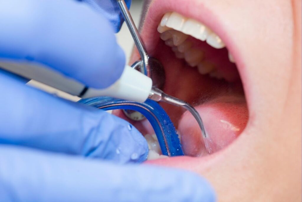 Diş taşı birikimini ve diş taşı temizliği işleminin diş eti sağlığına etkisini gösteren ağız içi görsel.