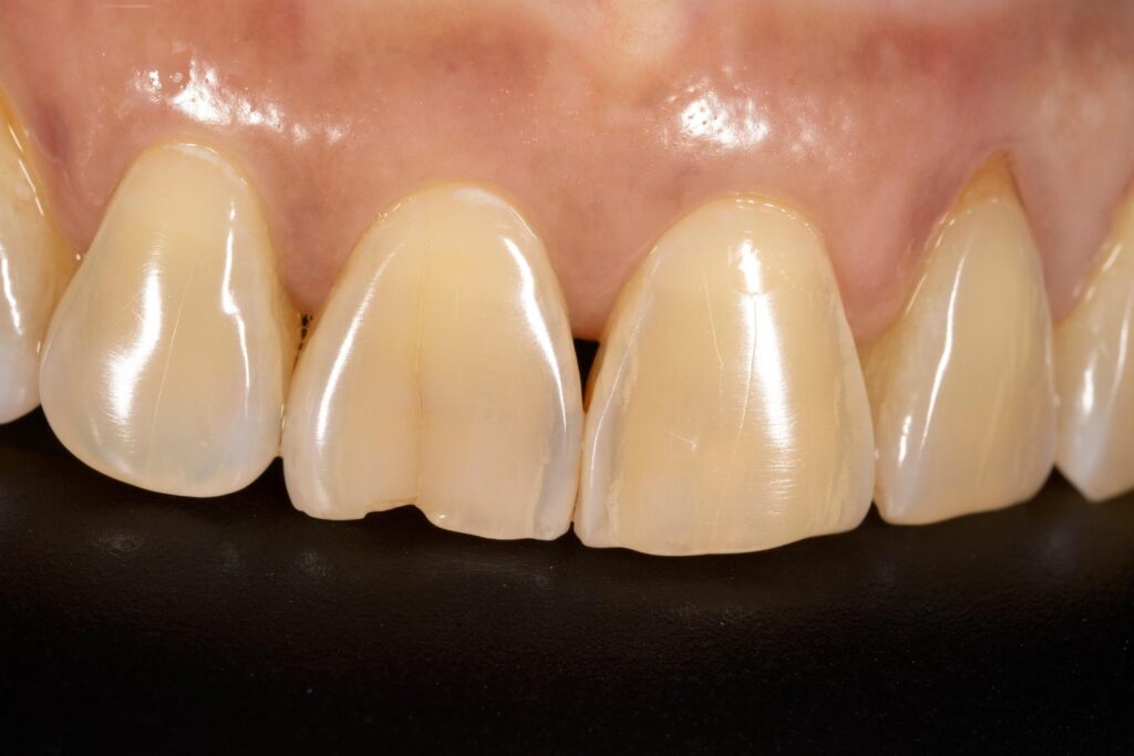 Diş minesinde beyaz leke oluşumunu ve mine tabakasının yapısını gösteren şematik ağız içi görsel.