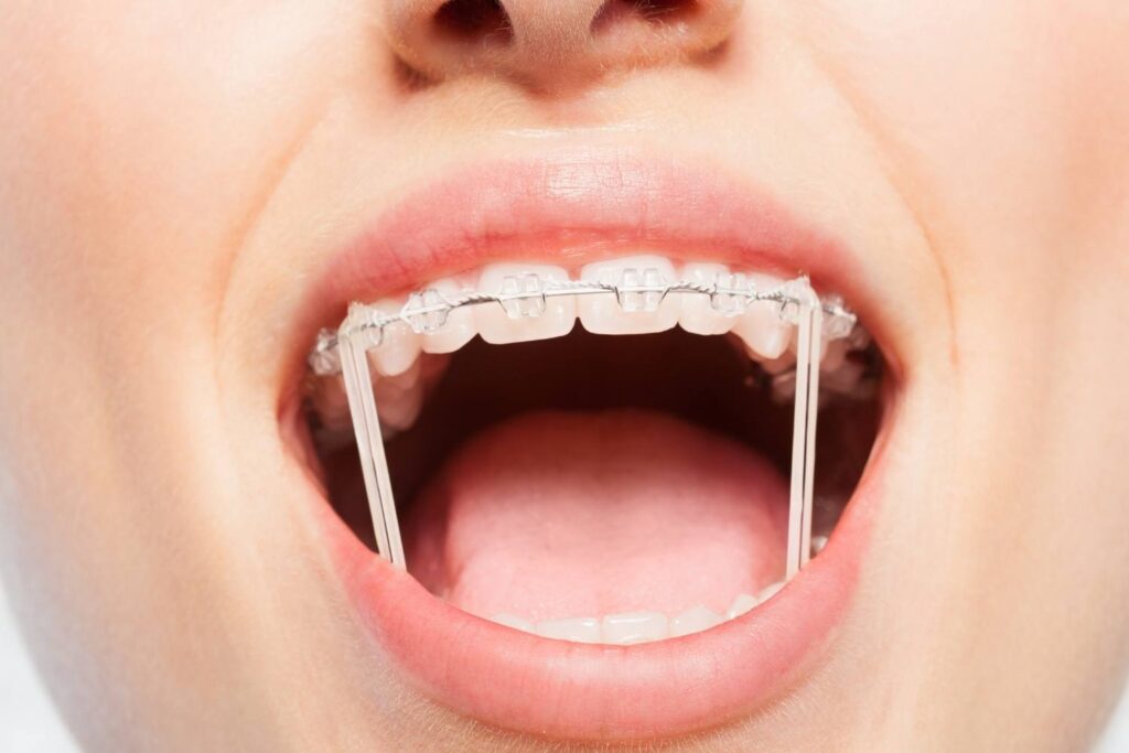 Ortodontik tedavi sırasında braketli dişlerin doğru fırçalama ve arayüz temizliğiyle bakımını gösteren görsel.