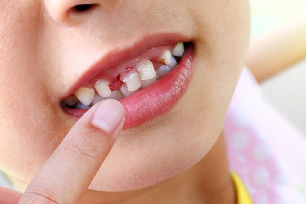 Biberon çürüğünün süt dişlerinde oluşturduğu erken dönem çürük görünümünü ve ağız içi muayene sürecini gösteren görsel.