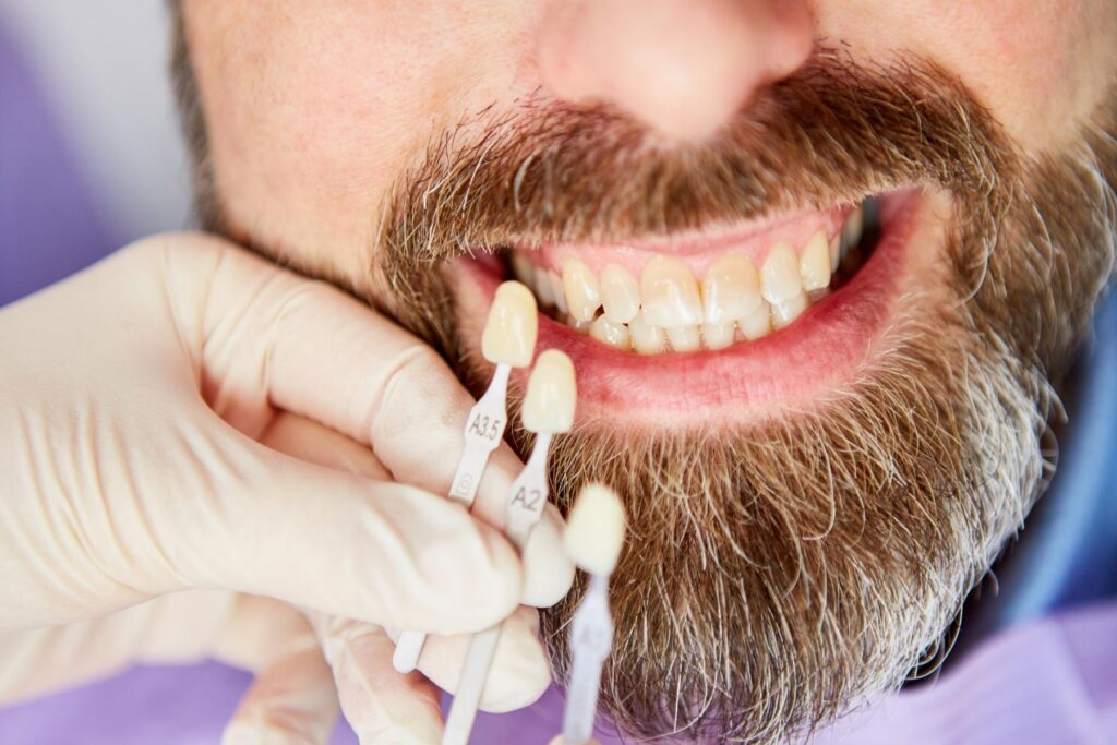 Günlük alışkanlıklara bağlı diş renklenmelerini ve diş yüzeyindeki lekelenme tiplerini gösteren ağız içi görsel.