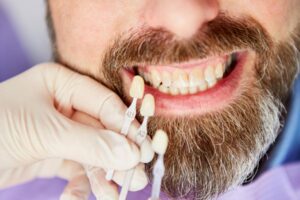 Günlük alışkanlıklara bağlı diş renklenmelerini ve diş yüzeyindeki lekelenme tiplerini gösteren ağız içi görsel.