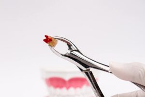 Alt çenede yarı gömülü 20’lik dişi gösteren panoramik diş röntgeni görseli.