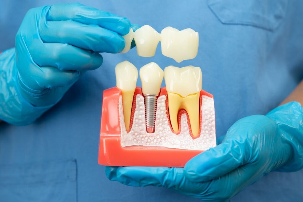 Diş implantı yerleştirilecek çene kemiğinde kemik yoğunluğunu gösteren panoramik röntgen görüntüsü.