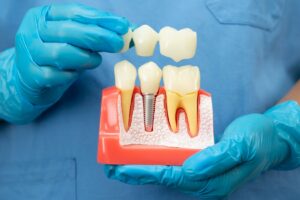 Diş implantı yerleştirilecek çene kemiğinde kemik yoğunluğunu gösteren panoramik röntgen görüntüsü.