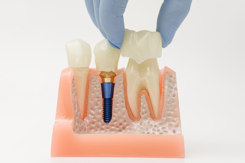 Diş implantı planlamasında çene kemiğinin incelendiği panoramik röntgen görüntüsü.
