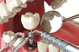 implant-cevresindeki-yumusak-dokular-neden-onemlidir