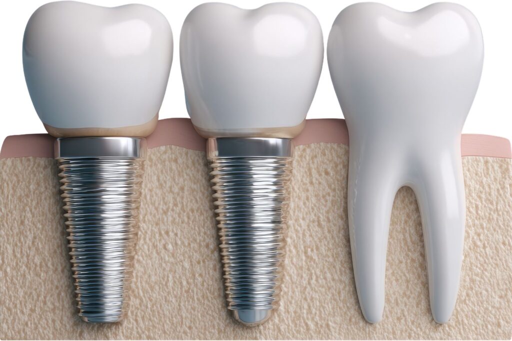 İmplant çevresindeki diş eti ve kemik dokusunun değerlendirildiği peri-implantitis temalı diş hekimliği görseli.