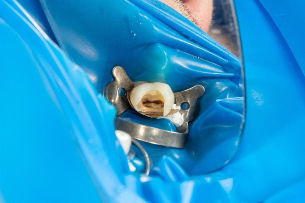 Kanal tedavili bir dişte yeniden ağrı nedenlerinin klinik ve radyografik olarak değerlendirildiği endodonti muayenesi.