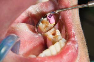 Kanal tedavisi öncesinde diş kökleri ve kanal yapısının radyografik olarak değerlendirildiği endodonti muayenesi.
