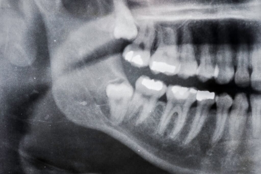 20 yaş dişi çekimi sonrası alveolit gelişen çekim boşluğu ile normal iyileşme sürecinin dental olarak değerlendirilmesi.