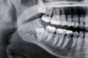 20 yaş dişi çekimi sonrası alveolit gelişen çekim boşluğu ile normal iyileşme sürecinin dental olarak değerlendirilmesi.