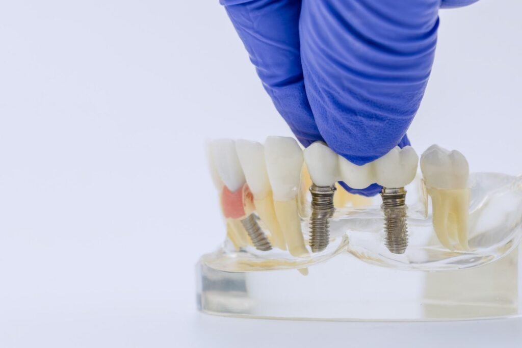 Eksik diş bölgesine yerleştirilen dental implantın çene kemiği, abutment ve protez bileşenleriyle anatomik gösterimi.