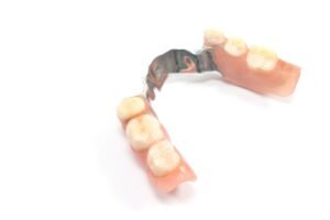 Eksik dişlerin tamamlanmasında kullanılan kancalı hareketli bölümlü protezin ağız içindeki yerleşimini gösteren dental görsel.
